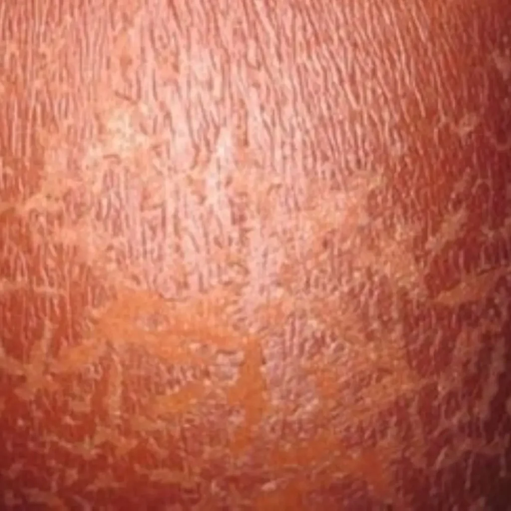 eritema-solare